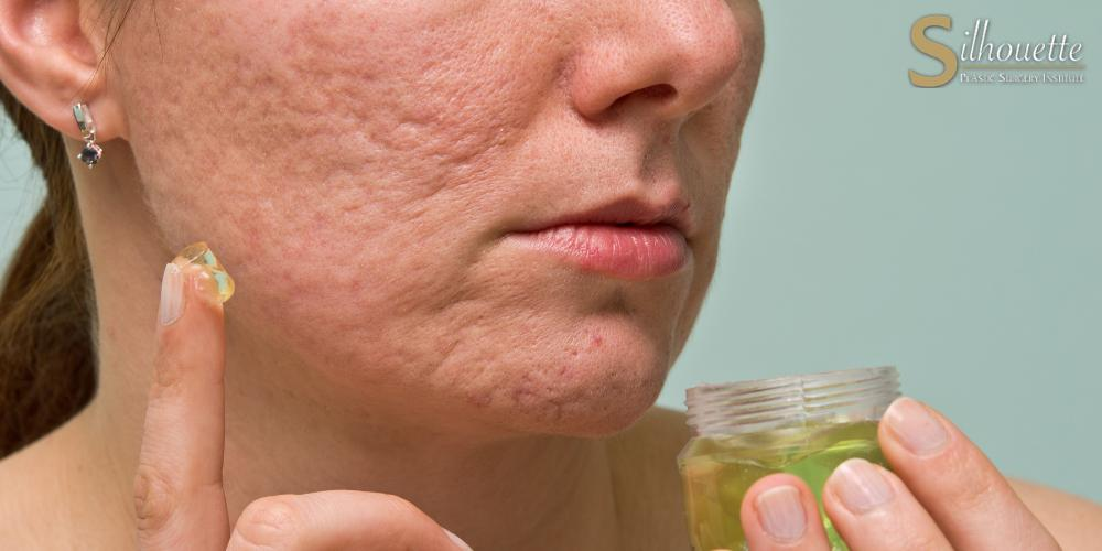 How to Reduce Acne Scars at Home Naturally