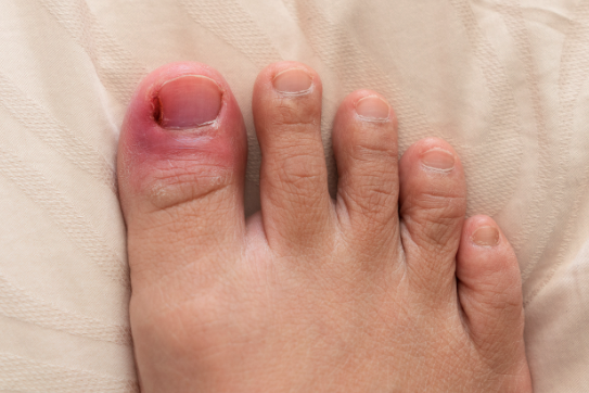 Managing Recurring Ingrown Toenails: Long-Term Solutions