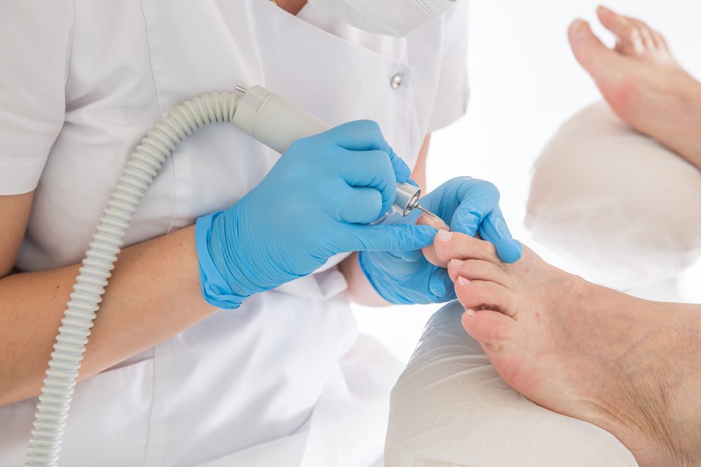 Common Questions About Fungal Nails