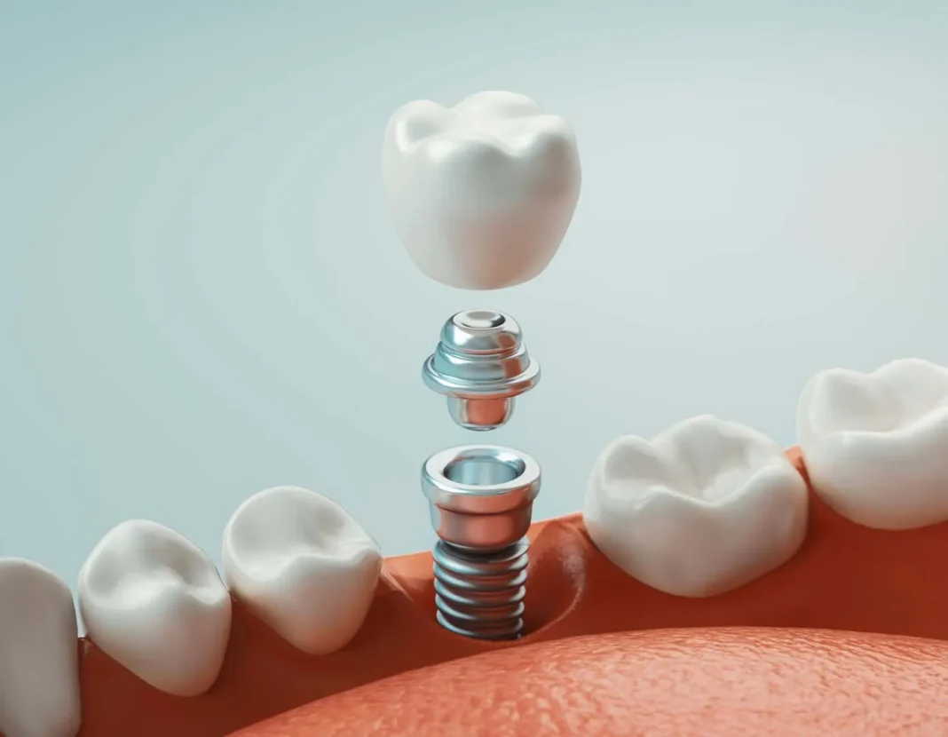 FAQs About Endodontic Implants