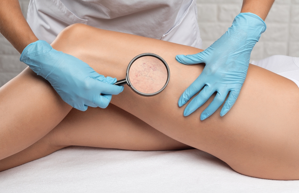 How to Prepare for Your Vein Center Appointment and What to Expect