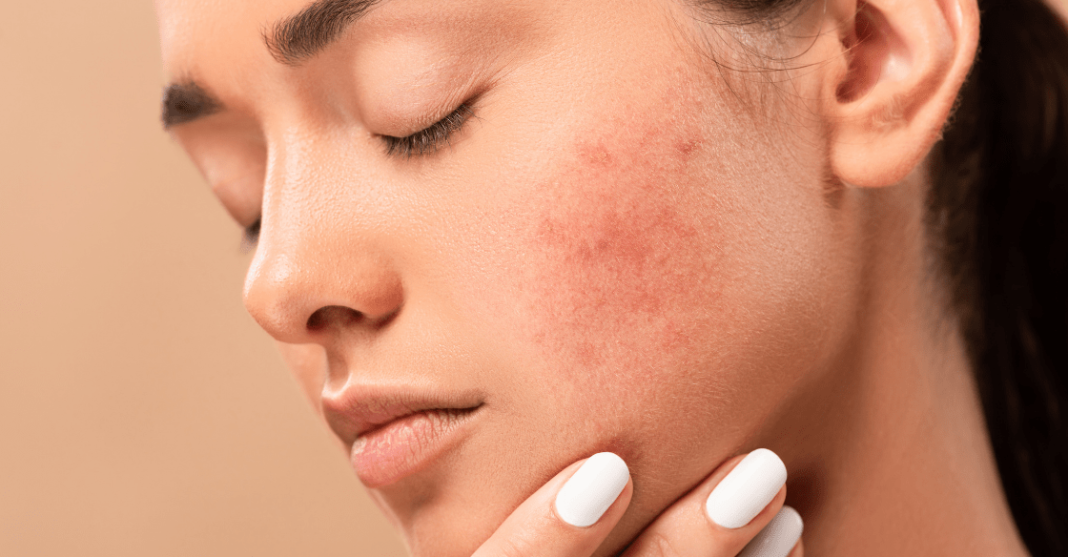 Skin Cancer Myths and Facts You Need to Know