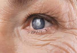 Symptoms, Causes, and Treatment Options for Cataracts