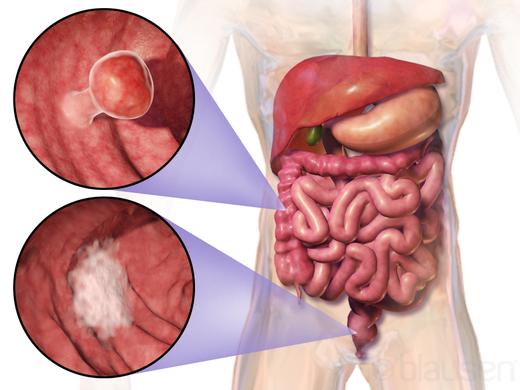 What Is Colorectal Cancer?