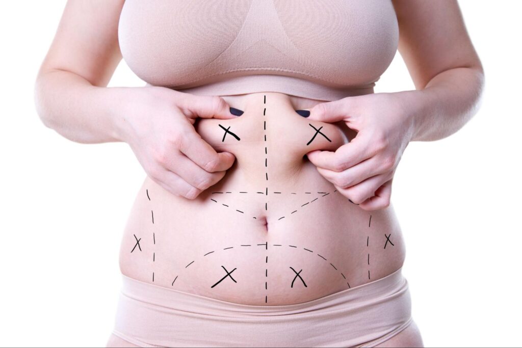 What Is Liposuction and Should I Get One?