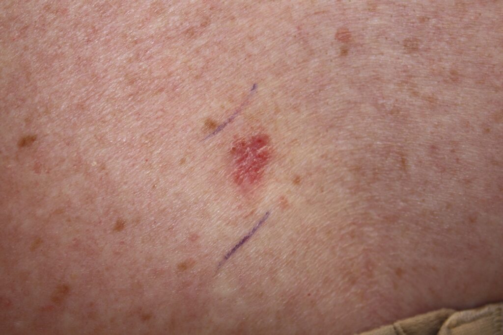 4 Signs of Skin Cancer