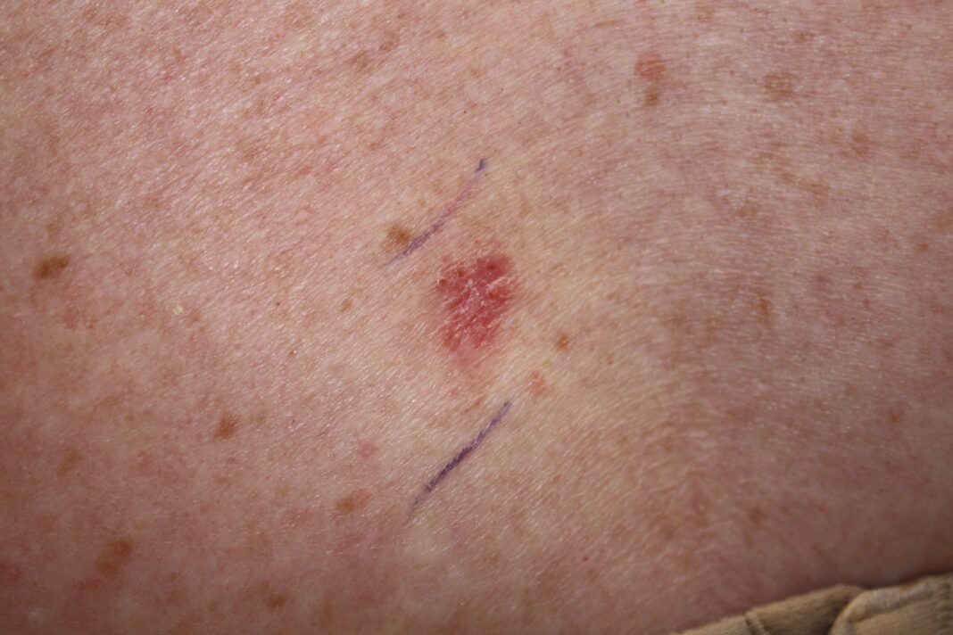 4 Signs of Skin Cancer