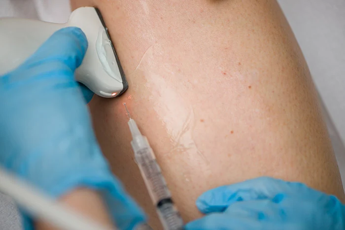 How to Manage Varicose Veins with Regular Exercise