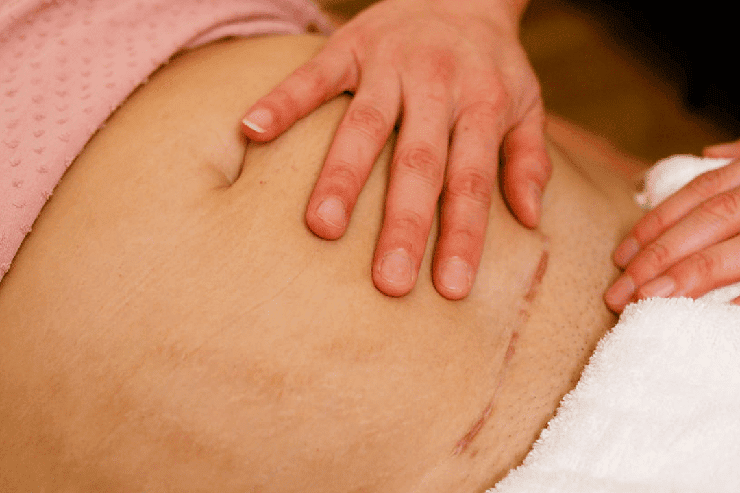 Post-Surgery Care for Scar Revision