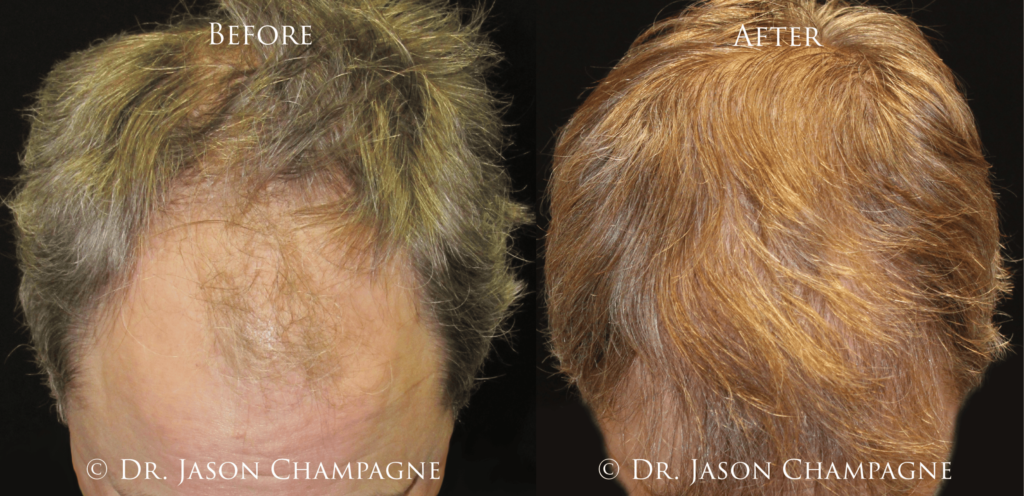 Post-procedure Care for Optimal Hair Transplant Results