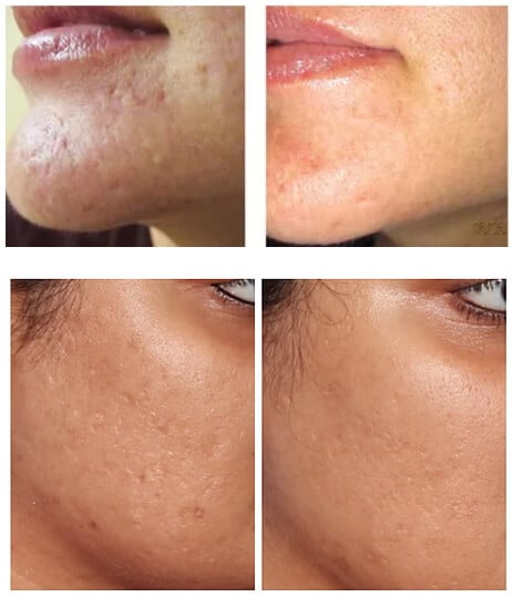 The Benefits of Mohs Surgery in Skin Cancer Treatment