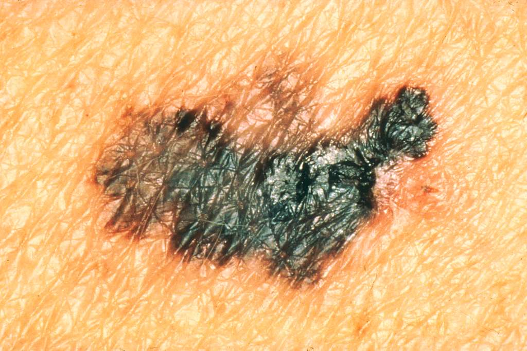 The Importance of Regular Skin Checks for Melanoma