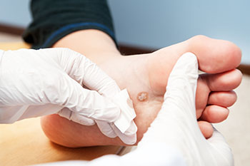 The Link Between Plantar Warts and Skin Health
