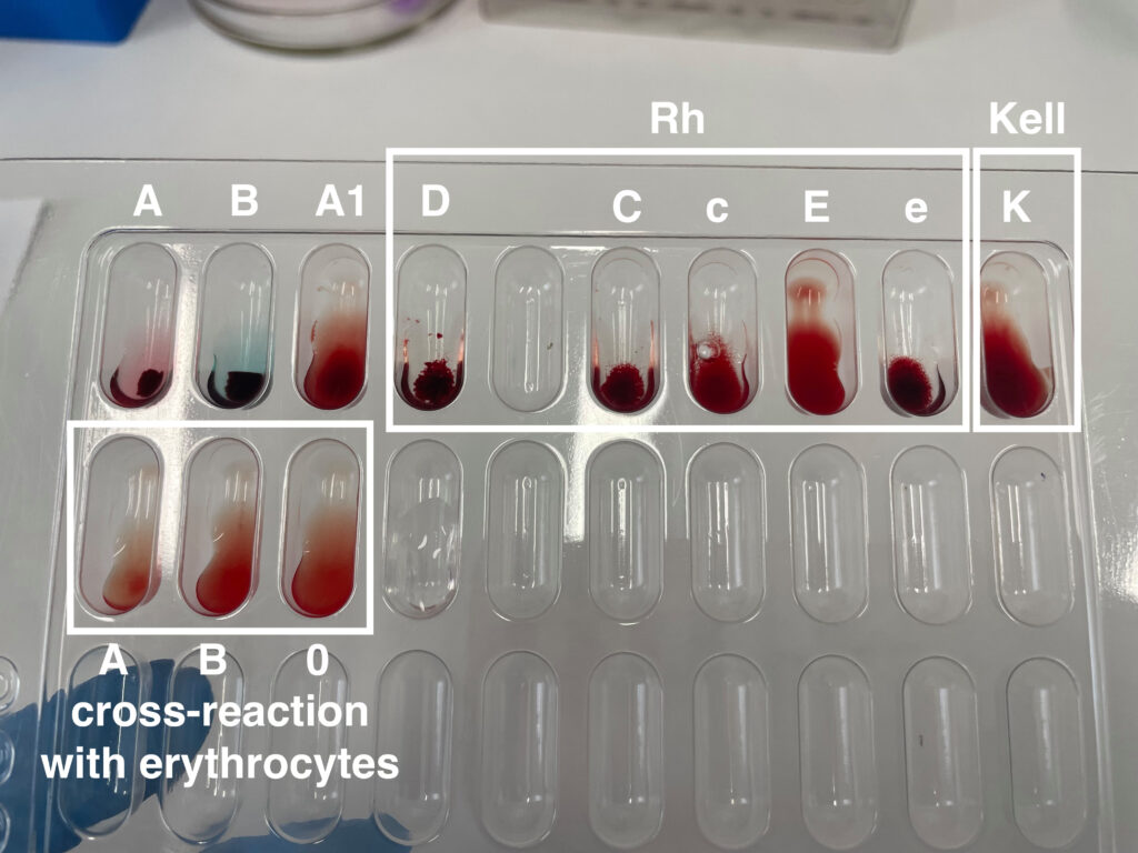 Understanding the Different Types of Blood Work