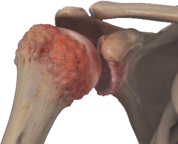 The Latest Advances in Shoulder Replacement Surgery